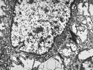 F,31y. | mucoepidermoid carcinoma F,31y. | mucoepidermoid carcinoma